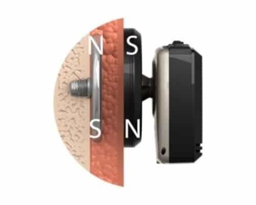 Hearing loss in adults — clinical image 1