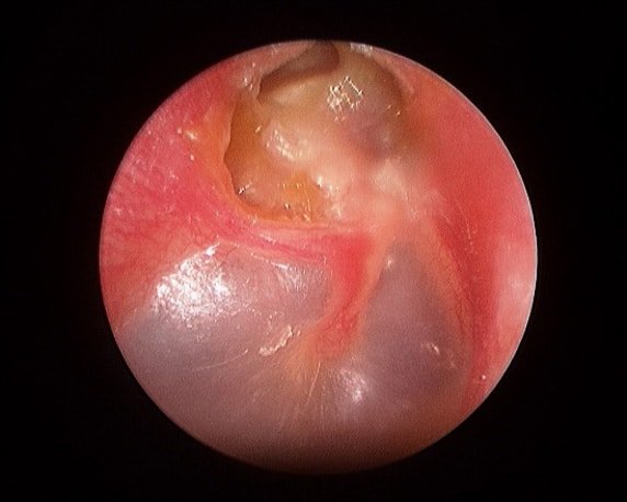Cholesteatoma — clinical image 1