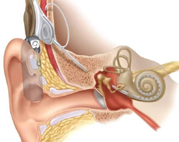 Cochlear implants and hearing implants — clinical image 1