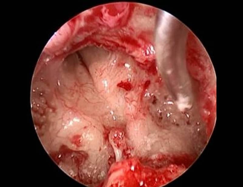 Endoscopic ear surgery — clinical image 1