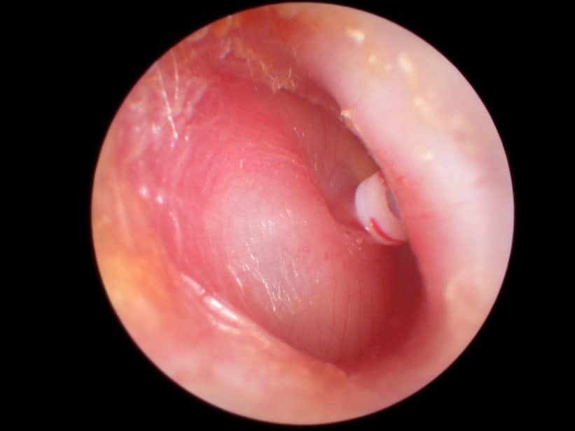 Glue ear (otitis media with effusion) — clinical image 1
