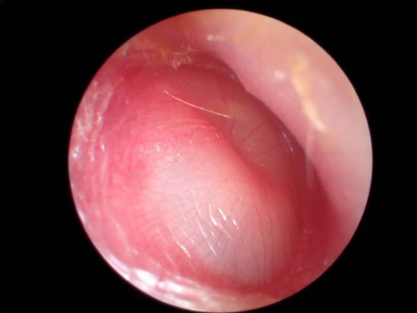 Glue ear (otitis media with effusion) — clinical image 1