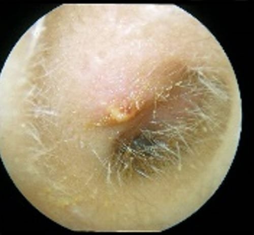 Ear infections and swimmer's ear (otitis externa) — clinical image 1