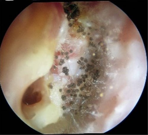 Aspergillus niger otitis externa.