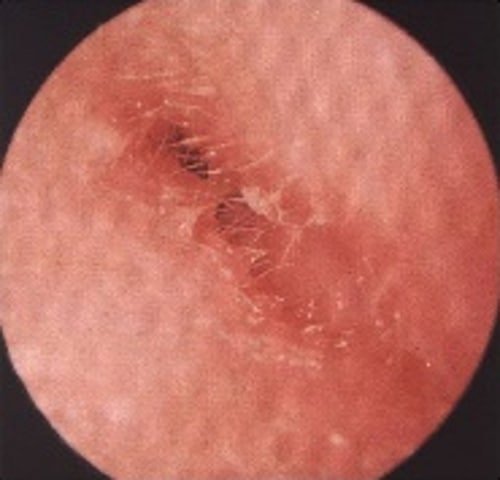 Ear infections and swimmer's ear (otitis externa) — clinical image 1