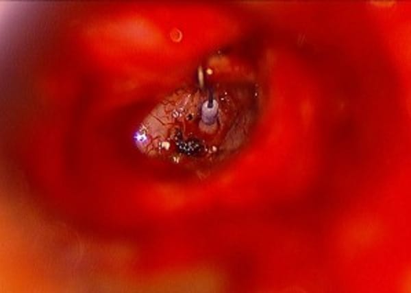 Otosclerosis — nitinolpiston