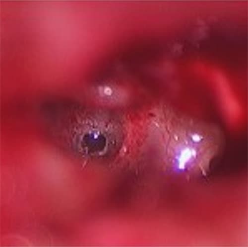 Otosclerosis — stapedotomy