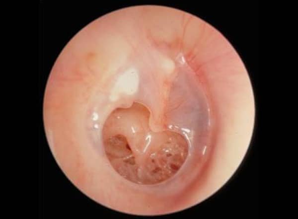 Perforated ear drum (tympanic membrane perforation) — clinical image 1