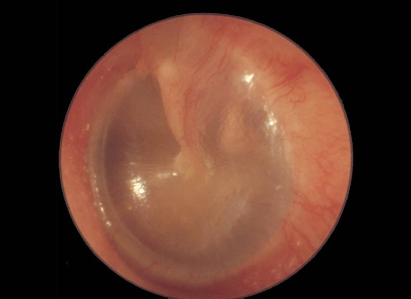 A picture of a normal tympanic membrane.