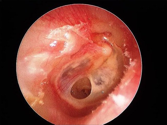 Perforated ear drum (tympanic membrane perforation) — clinical image 1