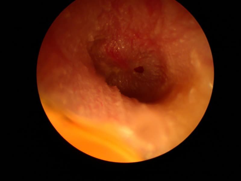 Perforated ear drum (tympanic membrane perforation) — clinical image 1