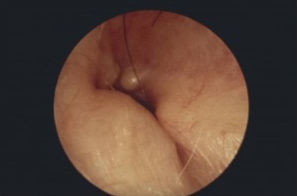 Surfer's ear (exostoses) — clinical image 1