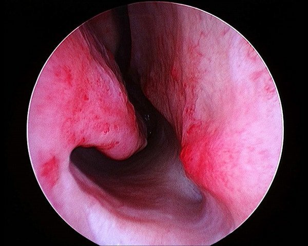 Hereditary hemorrhagic telangiectasia (condition of genetic predisposition to multiple telangiectasia)