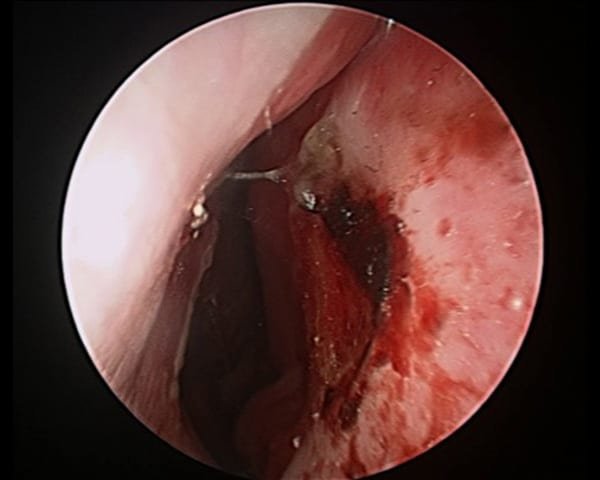 Septal ulceration (starts a localized infection but propagated but the finger!)