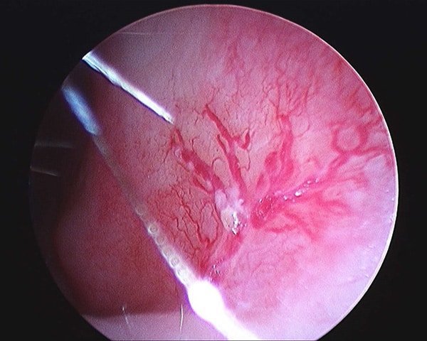 Small broken blood vessels (single telangiectasia)