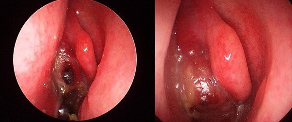 Nasal tumour