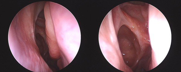 Recurrent or persistent ARS (post-surgery)