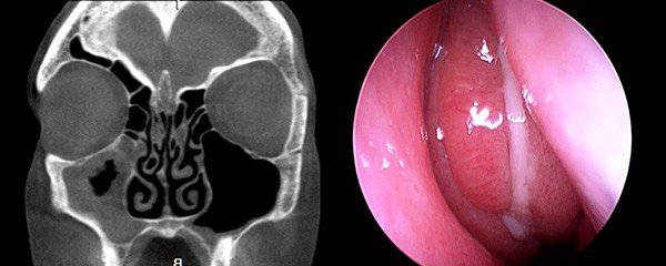 Recurrent or persistent ARS (pre-surgery)