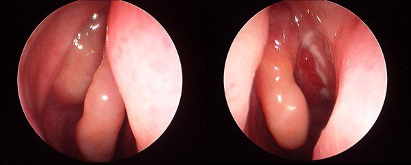 Acute sinusitis
