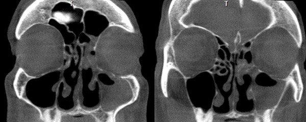 Acute sinusitis