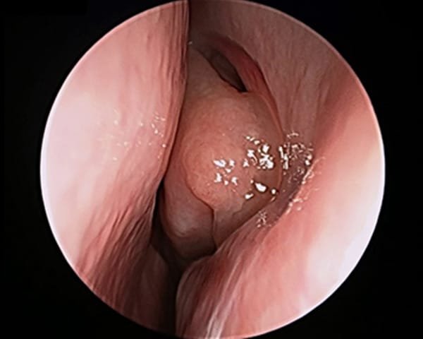 Allergic oedema (swelling) associated with allergies