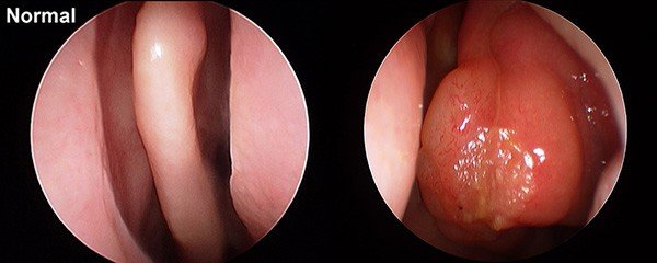 Allergic oedema (swelling) associated with allergies