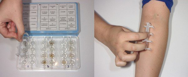 Skin testing to determine allergies