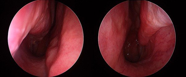Blocked nose and nasal breathing — clinical image 1