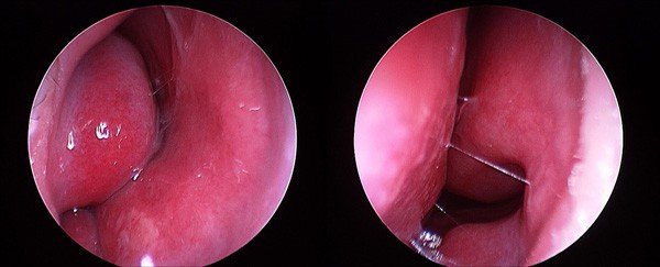 Rhinitis with turbinate hypertrophy (pre-surgery)