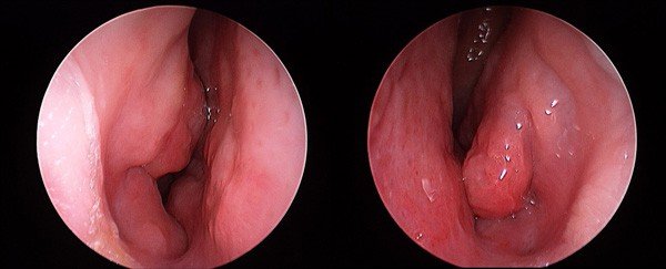 Rhinitis with turbinate hypertrophy (pre-surgery)