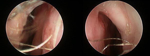 Septal Deviation (post-surgery)