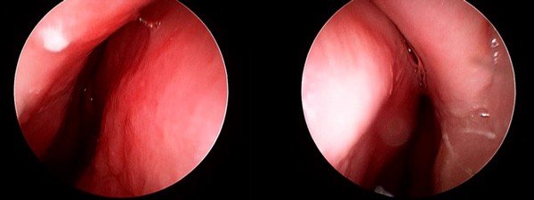 Septal Deviation (pre-surgery)
