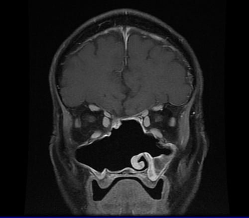 Tumour (post surgery)
