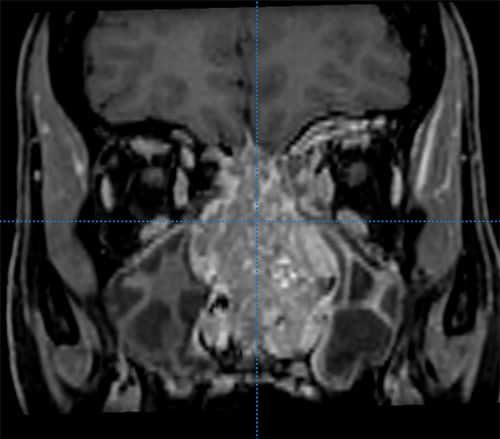 Tumour (pre surgey)
