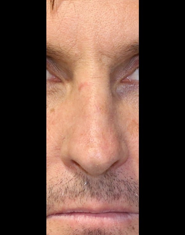 Broken nose (after acute surgery)