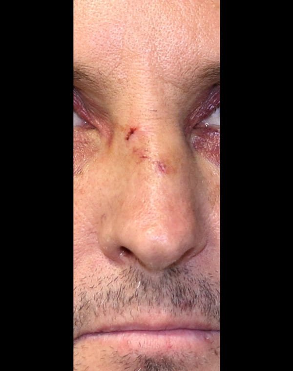 Broken nose (prior to acute surgery)