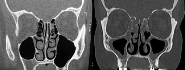 CT scan normal sinuses