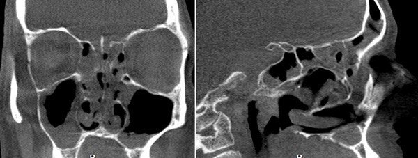 CT scan of chronic inflammatory rhinosinusitis