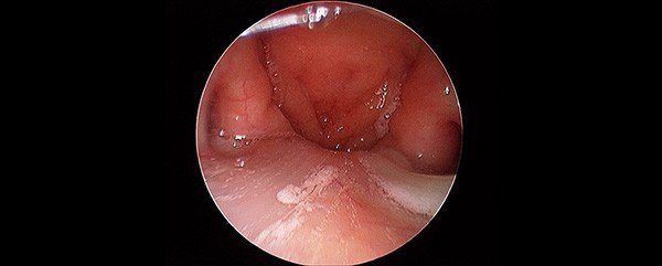 Infected mucus