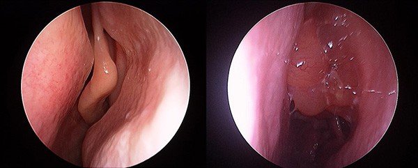 Nasal polyps