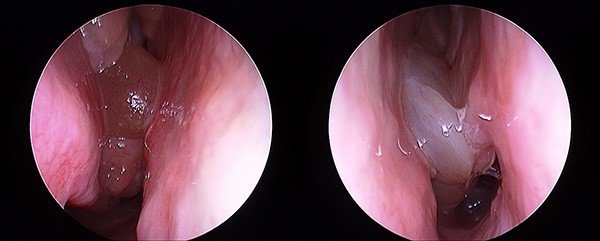 Nasal polyps