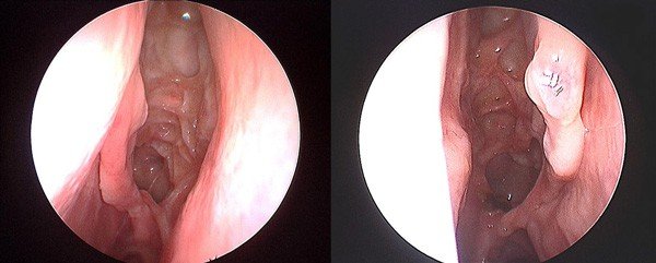 Healthy sinus cavity after sinus surgery