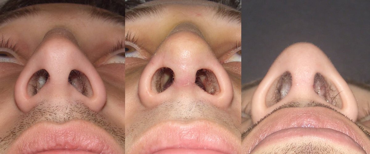 Columella incision (3 part)