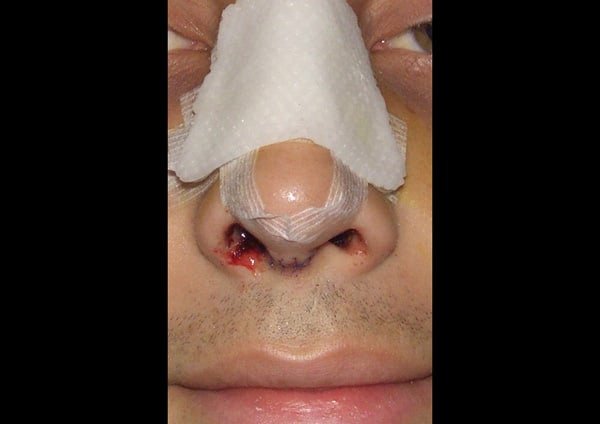 Columella incision (3 part)