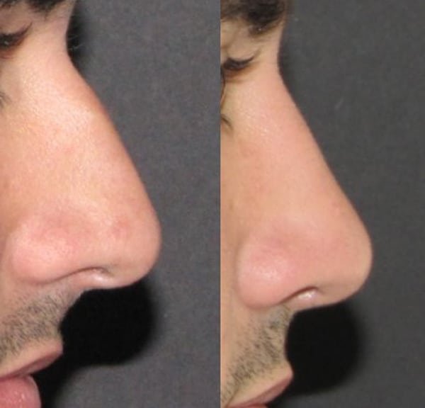 Dorsal reduction (2 part)