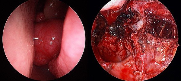 Large vascular (blood vessel) tumors (angiofibroma)