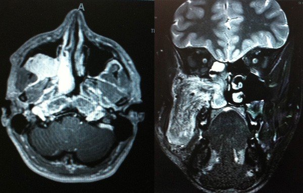 Large vascular (blood vessel) tumors (angiofibroma)