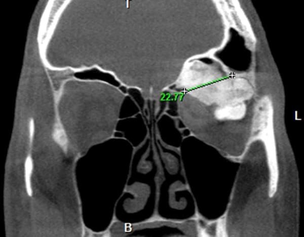 Bone tumours (osteomas)