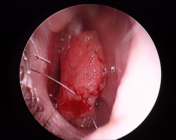 Benign tumours arising from the mucosal lining (papillomas)