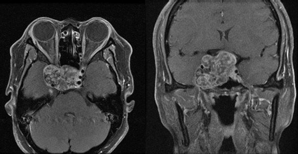 Malignant or cancerous tumours usually in older or adult patients